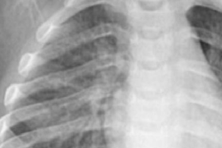 Pengesanan cepat pneumoniae Chlamydia: boleh dipercayai dan cekap